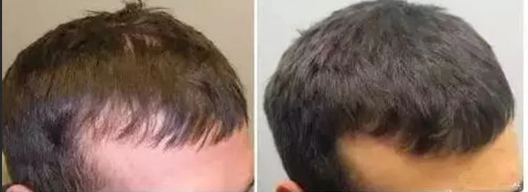 Minoxidil sulfate powder Functions